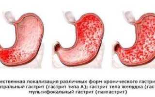 Как заболеть гастритом в домашних условиях быстро и эффективно