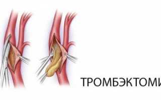 4 способа удаление тромбоза геморроидального узла — то, что помогает, когда консервативные подходы бессильны