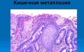 Чем опасна метаплазия желудка и как правильно ее лечить?