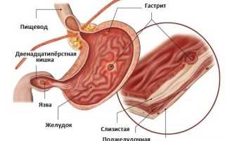Симптомы и особенности лечения алкогольного гастрита