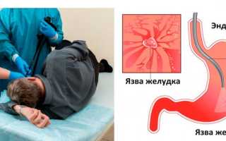 Чем лечить желудок в домашних условиях: лучшие народные и лекарственные средства